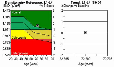 bone density chart by age