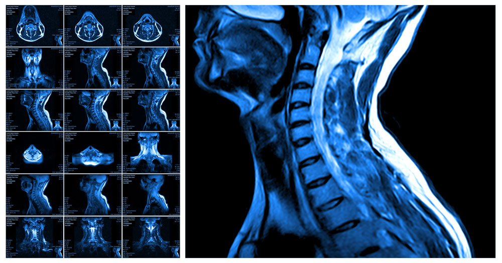 mri_115291227-1000